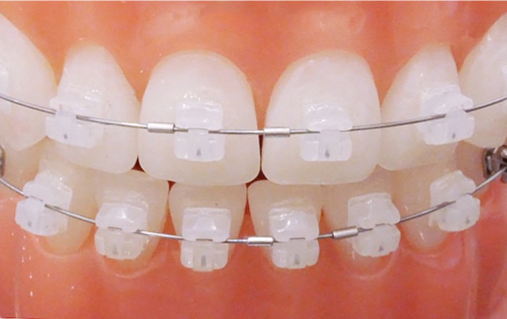 Orthodontic Treatment at YONSEI GOOD DAY Dental Clinic