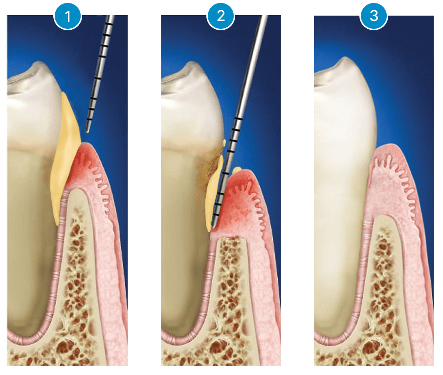 Periodontal Treatment at YONSEI GOOD DAY Dental Clinic