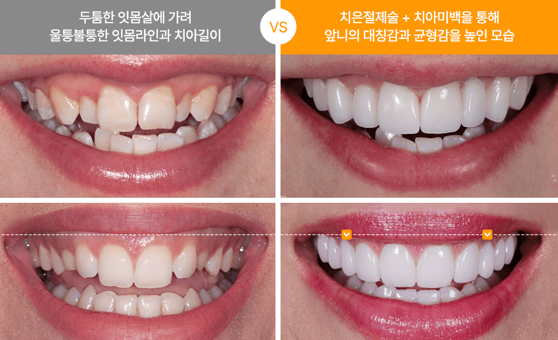 Gum Contouring in Gangnam – Reshape & Enhance Your Smile