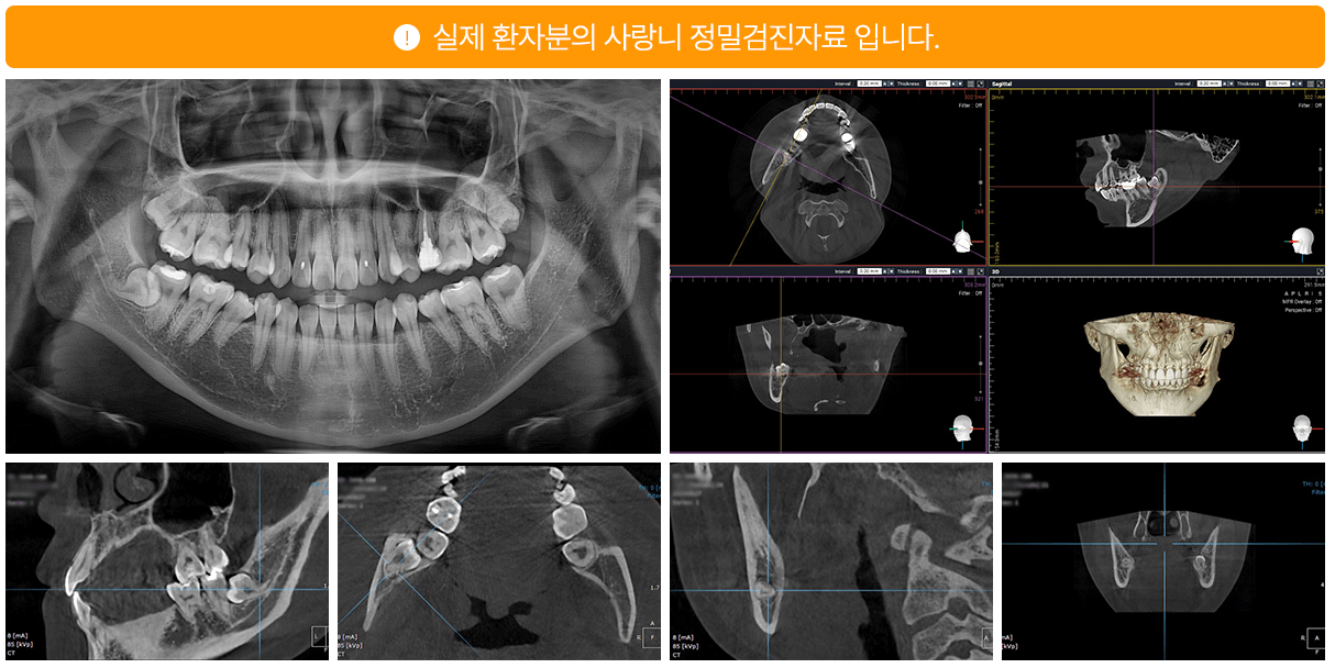 Panoramic dental X-ray and CT scan images of a jaw and teeth, highlighting dental structure and potential issues.