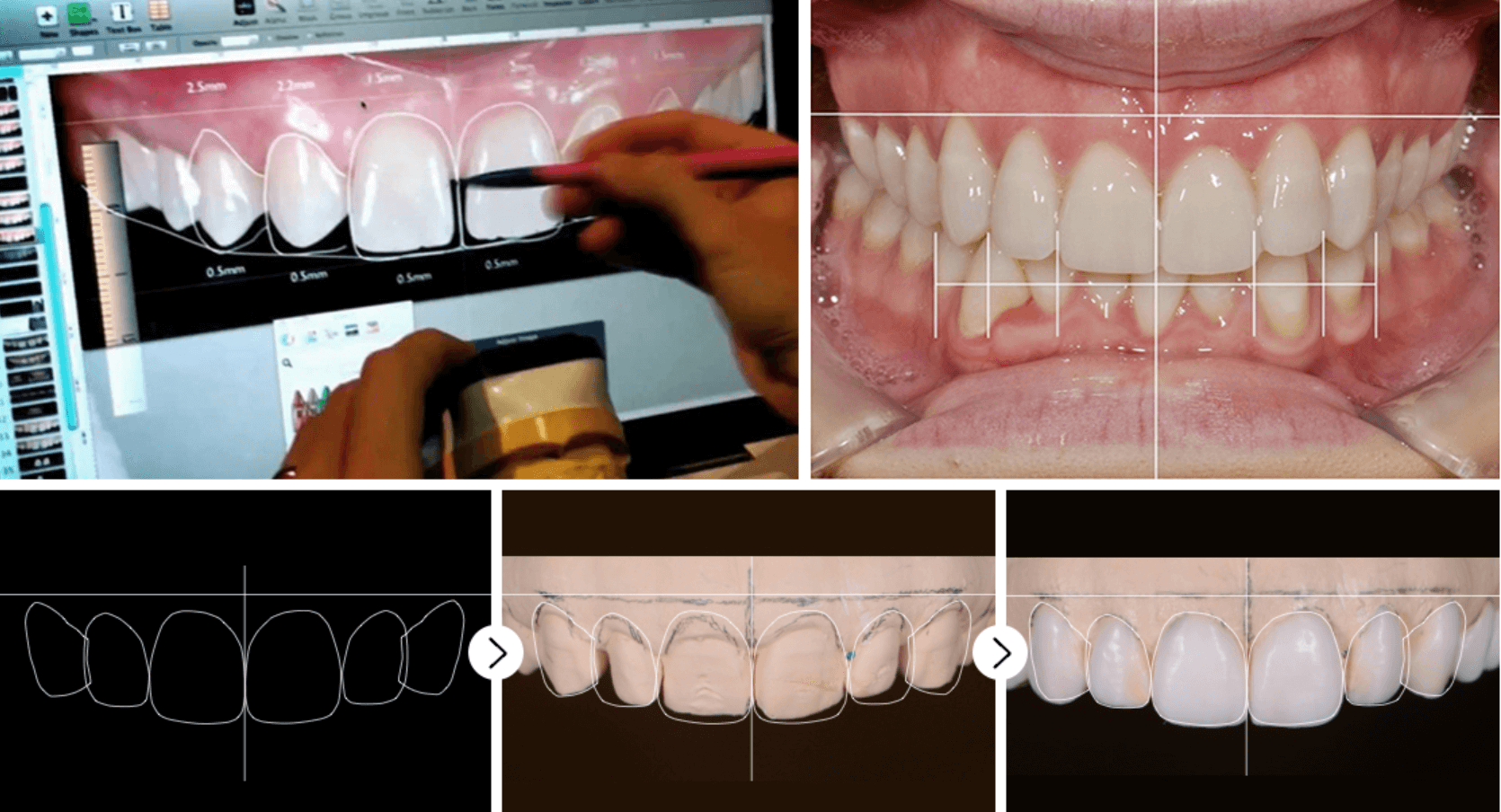 A dentist digitally designs and adjusts a patient's teeth, comparing a photo of the patient's smile to a model of the teeth.