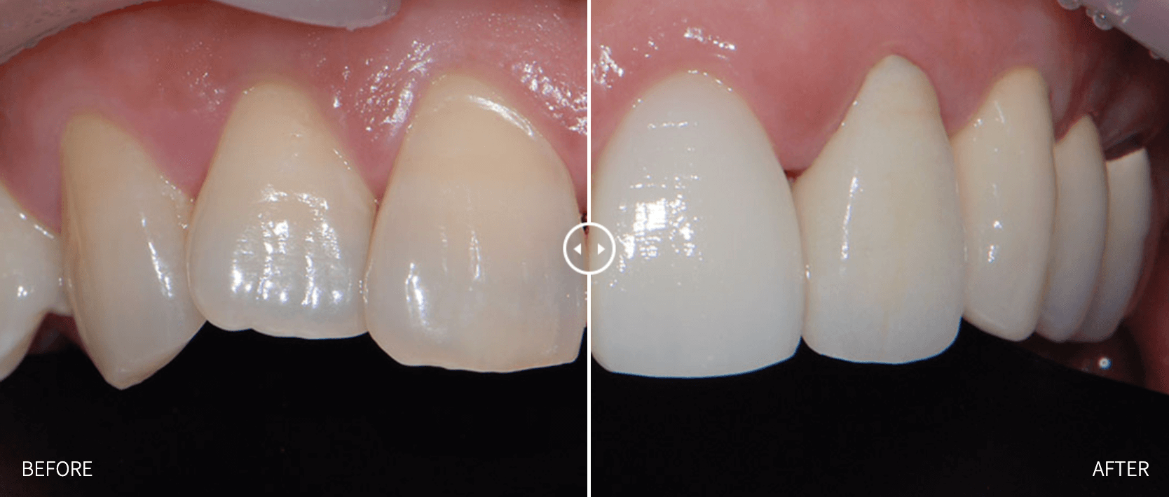 Before and after comparison of teeth. The