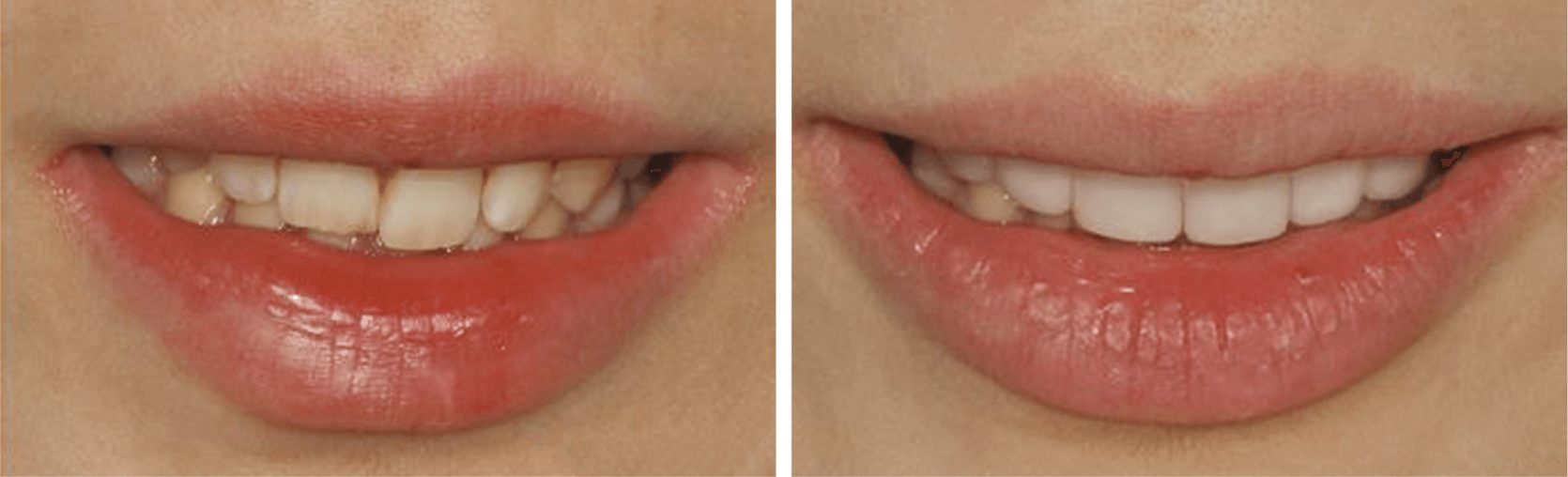 Before and after comparison of a person's smile; the left image shows uneven teeth, the right shows straight, white teeth.
