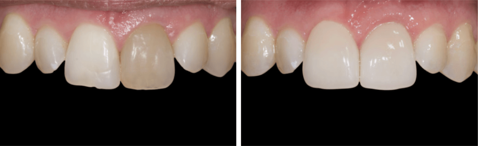 A before-and-after view of teeth. The before shows a discolored tooth, while the after shows a restored, bright, and even smile.