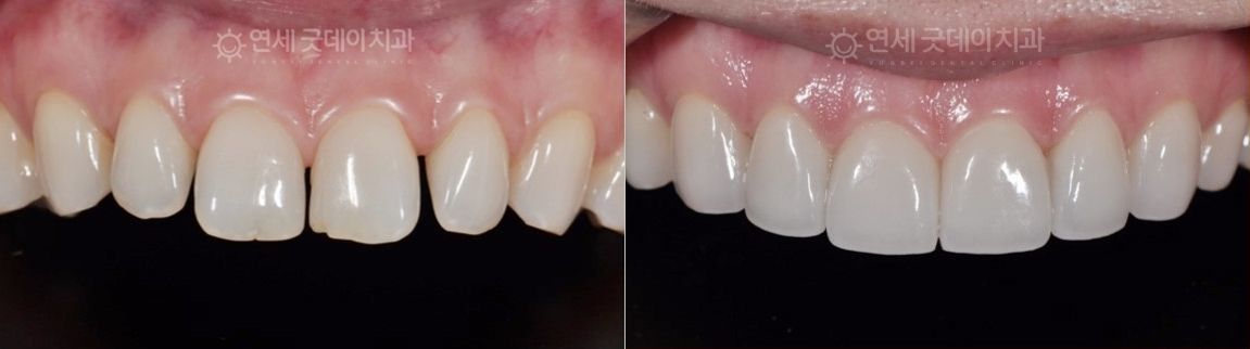 Before and after comparison of teeth. The