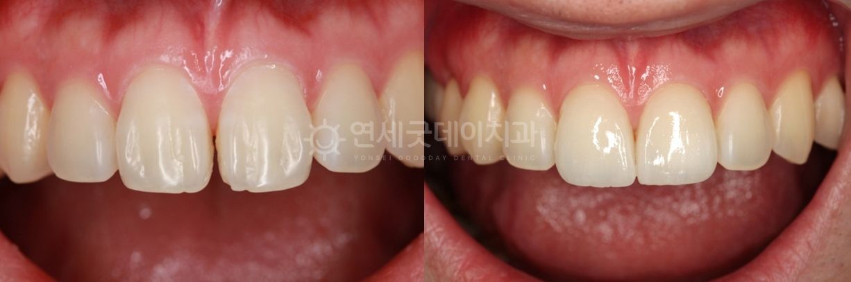 Before and after comparison of teeth. The