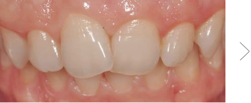 Close-up view of healthy, white teeth in a mouth, showing upper front teeth with slight overlap. Pink gums are visible.