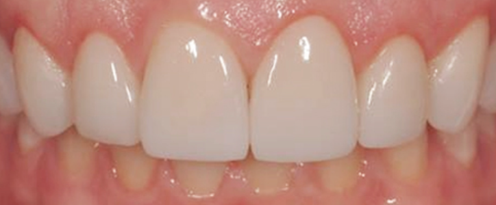 Close-up of bright white teeth with slight irregularities, set against pink gums.