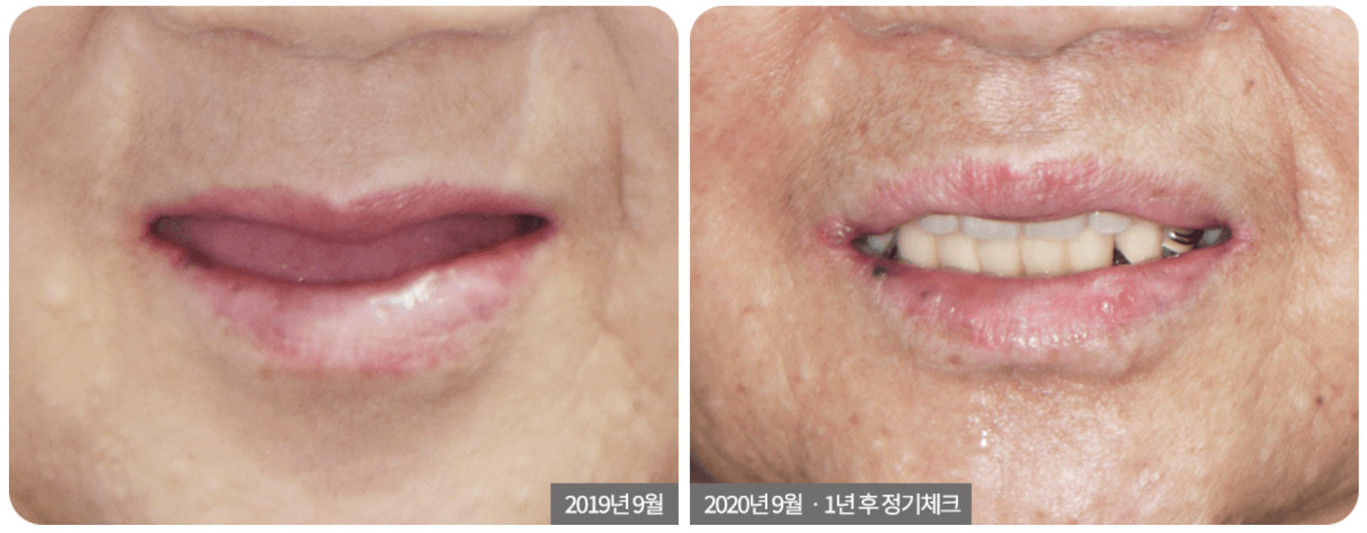A before-and-after comparison of a person's mouth. The