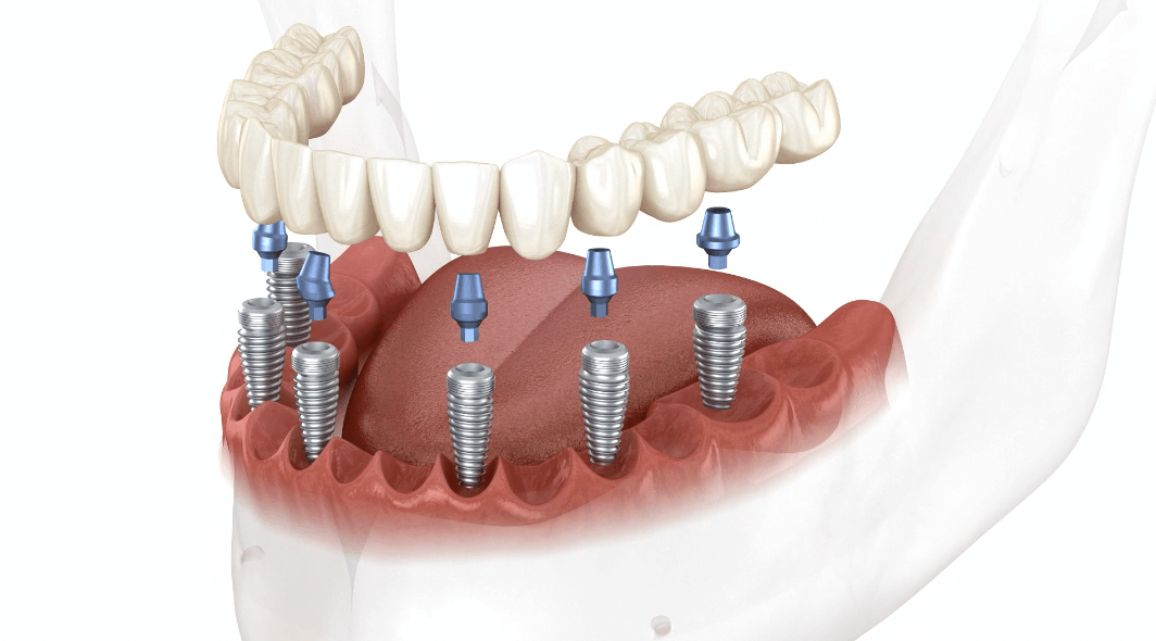 Implant Dentistry at YONSEI GOOD DAY Dental Clinic