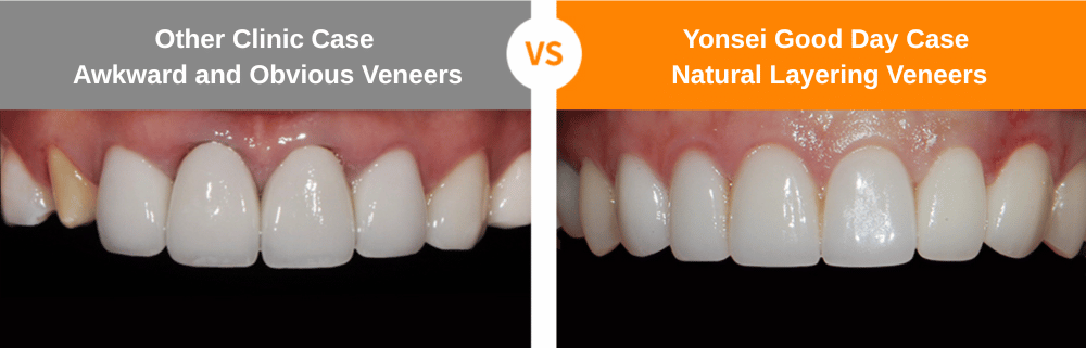 Side-by-side comparison of teeth with veneers: one set looks unnatural, the other set looks natural.