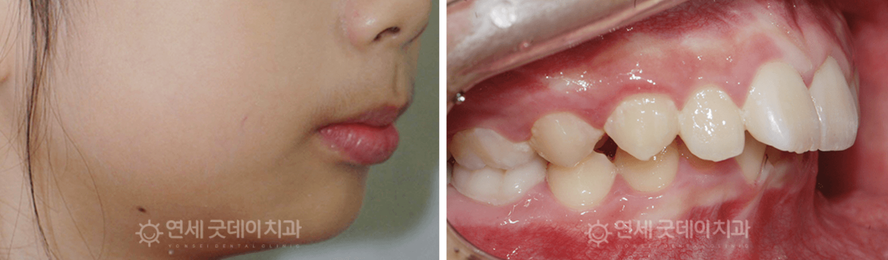 PEDIATRIC DENTISTRY IN GANGNAM – SPECIALIZED DENTAL CARE FOR CHILDREN