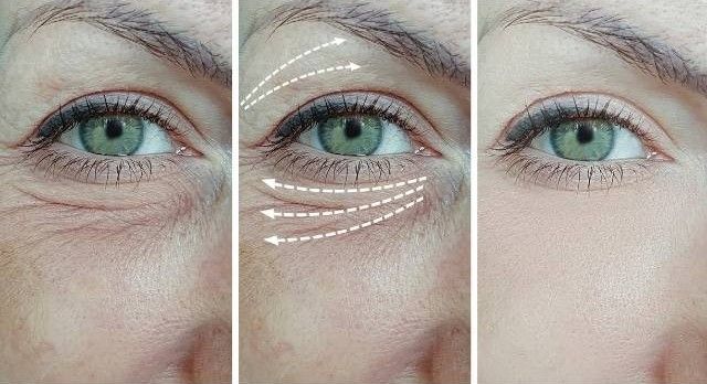 Close-up of the eye area showing crepey under-eye texture and the direction of tightening after plasma treatment