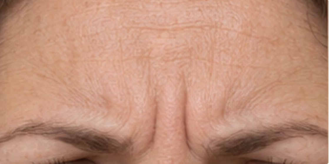 Forehead lines and frown lines between the brows