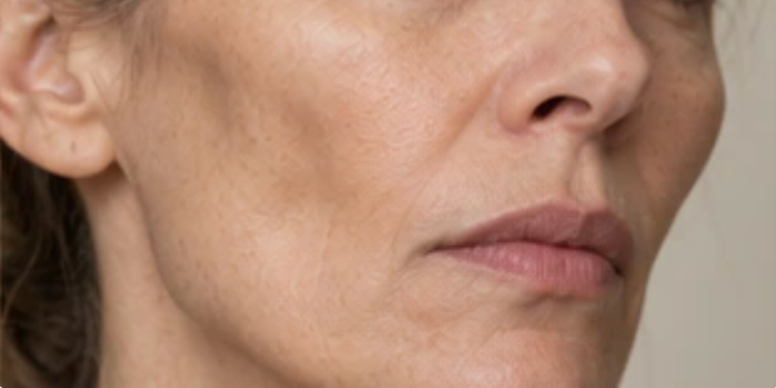 Flattened cheek with deepening smile and marionette folds