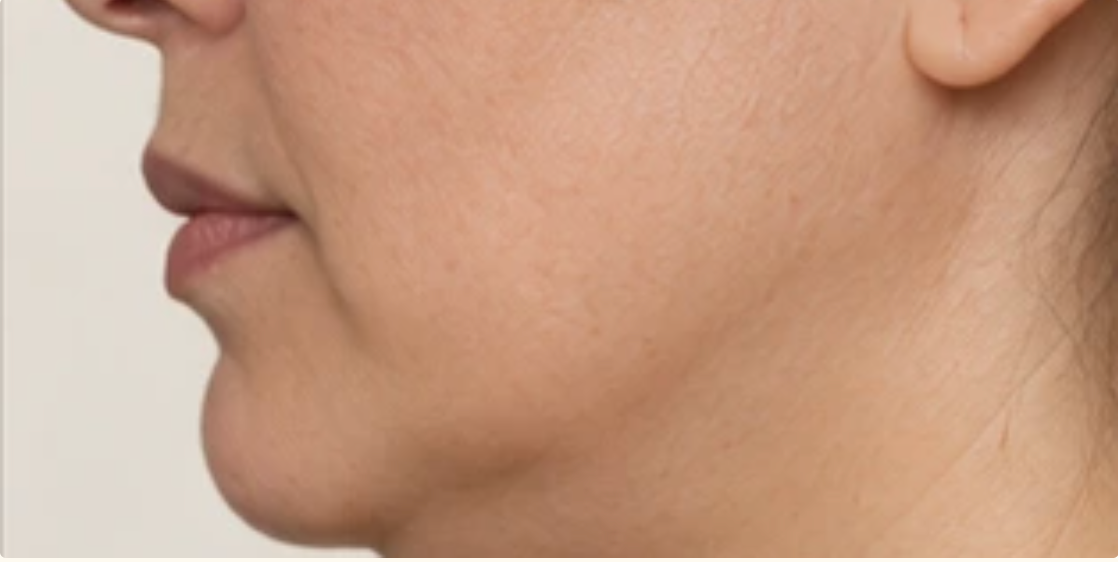 Profile showing chin projection and jawline definition