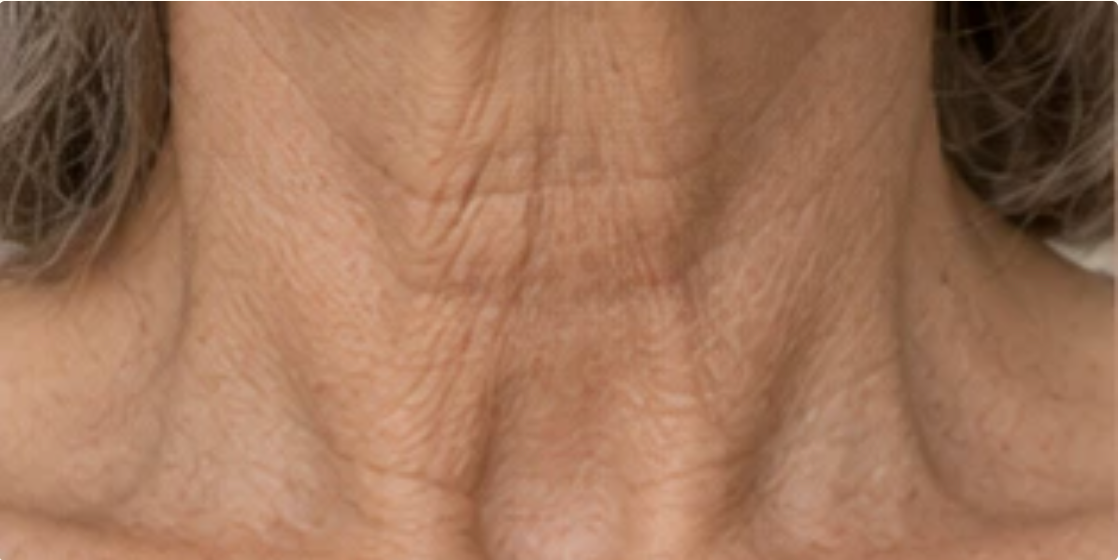 Skin along the neck and jawline showing loss of firmness and support