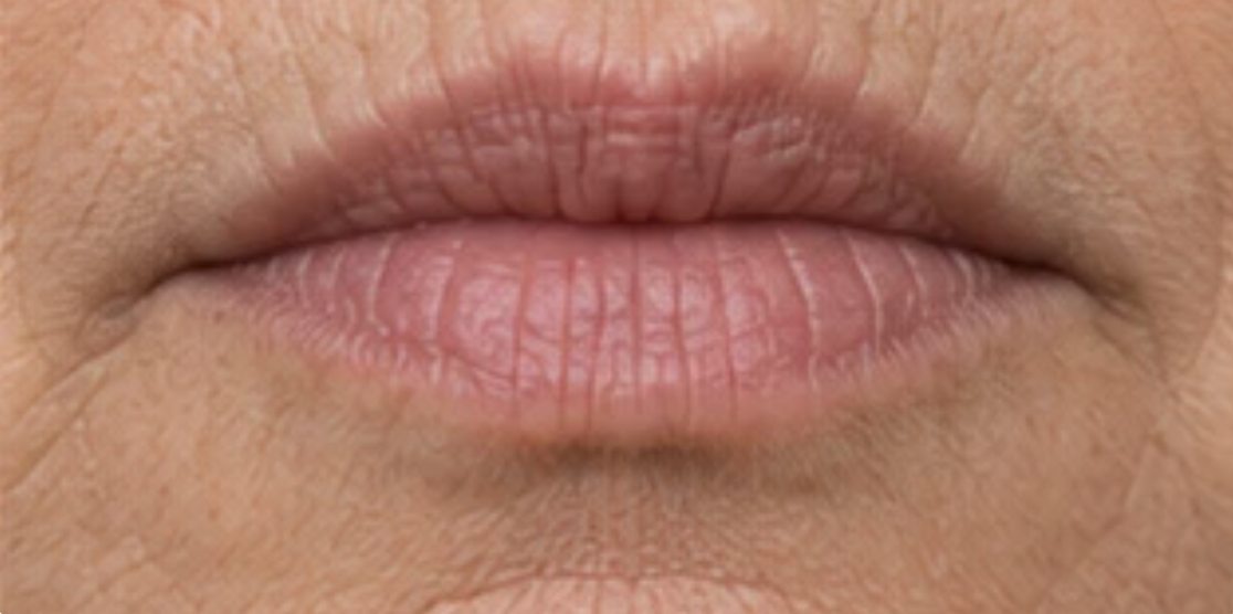 Lips showing fine lip lines and a softened border