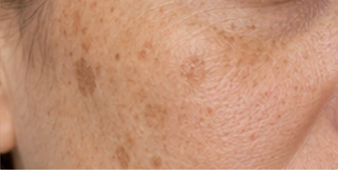 Cheek with scattered brown sun spots and age spots
