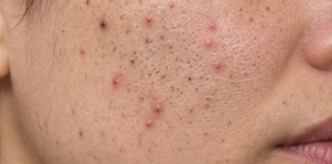 Cheek with active breakouts, congestion and clogged pores