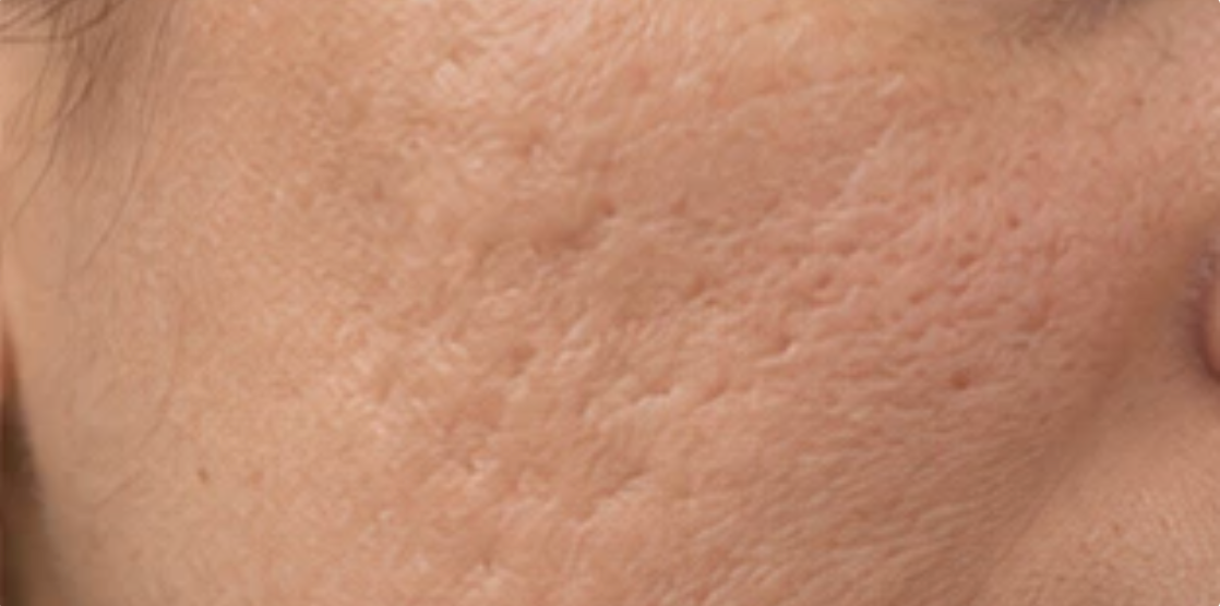 Cheek and jaw with indented acne scarring and uneven texture