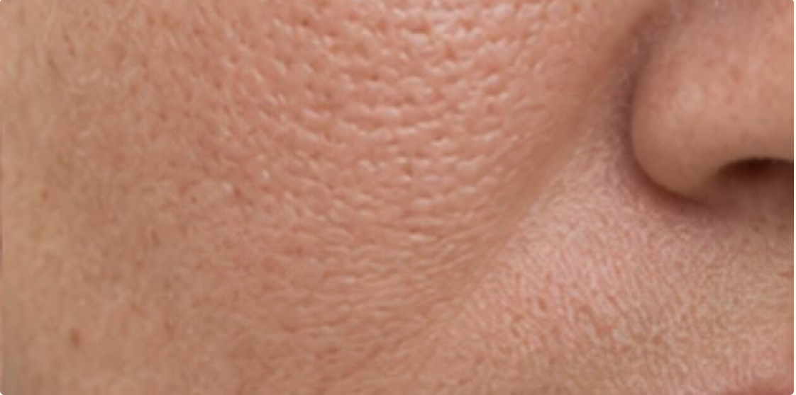 Cheek and nose with enlarged pores and rough surface texture