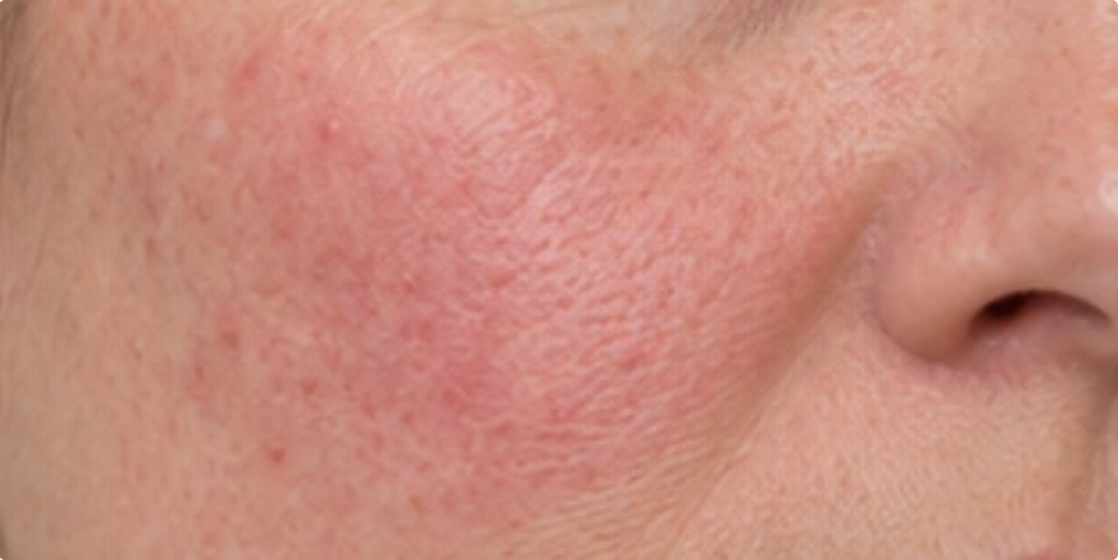 Cheek with persistent redness and flushing on reactive skin