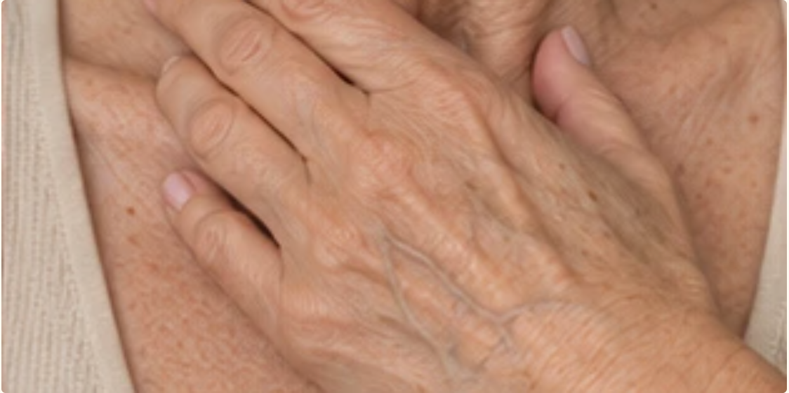 Thin, crepey skin on the hand and upper chest