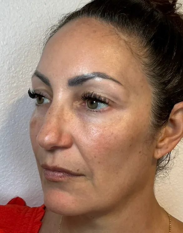 Full Face before NeoGen plasma skin regeneration