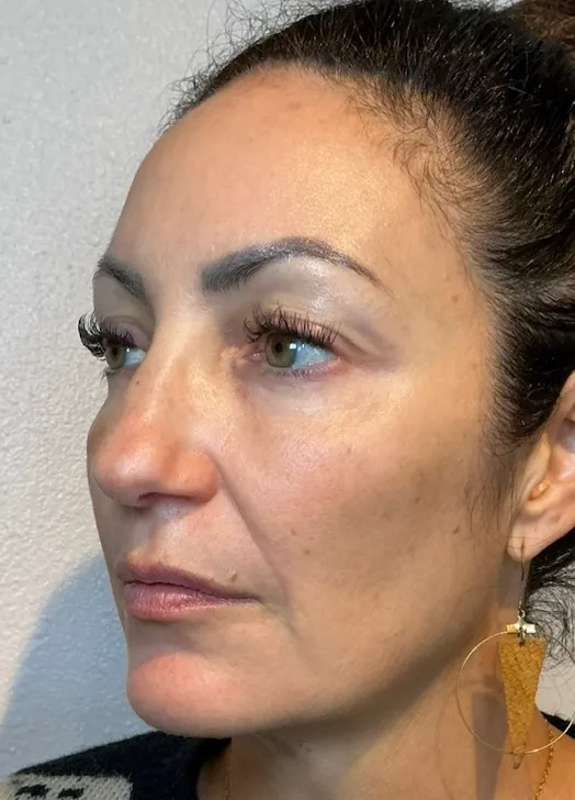 Full Face 60 Days After NeoGen plasma skin regeneration