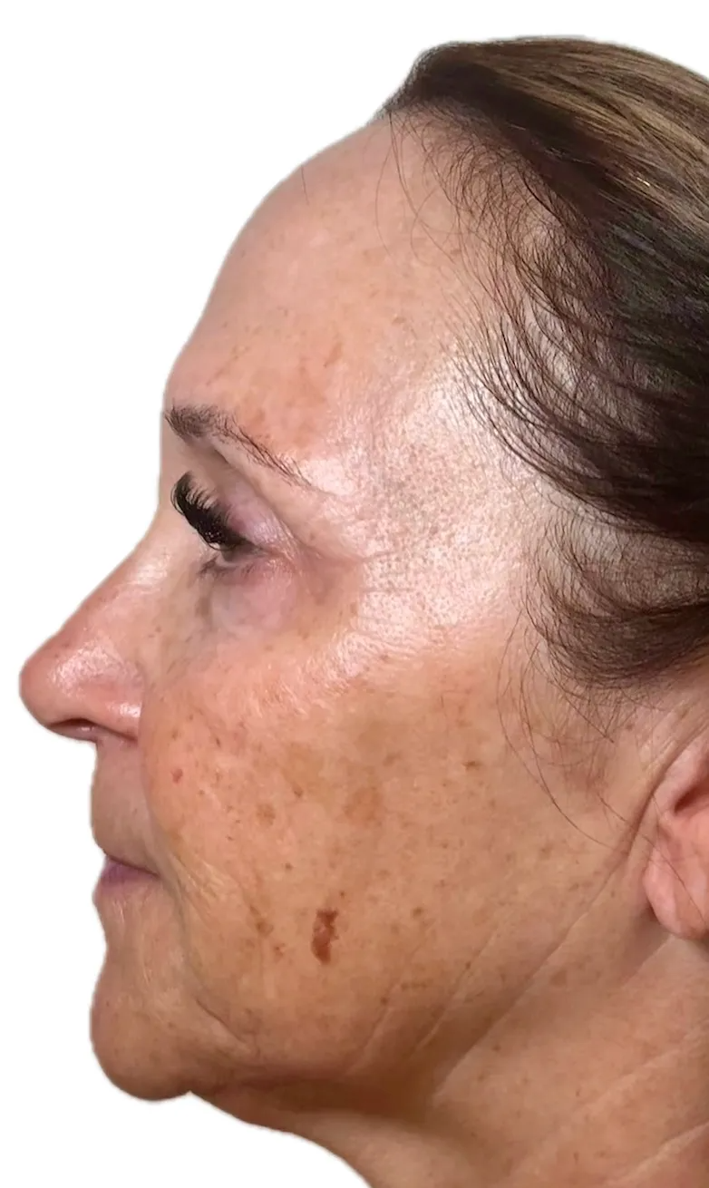 Side Profile before NeoGen plasma skin regeneration