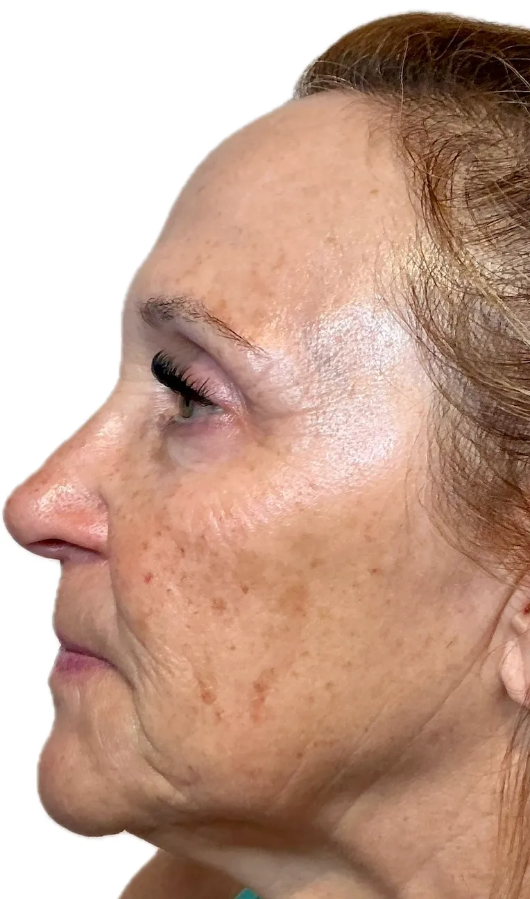 Side Profile 90 Days After NeoGen plasma skin regeneration