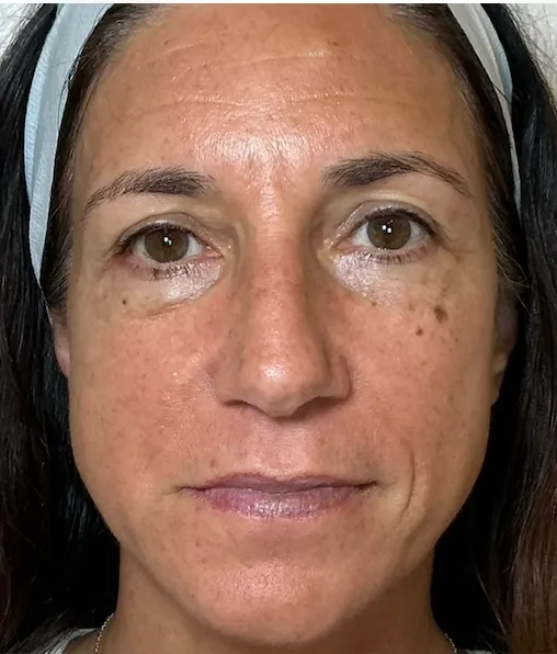 Healing Stage before NeoGen plasma skin regeneration