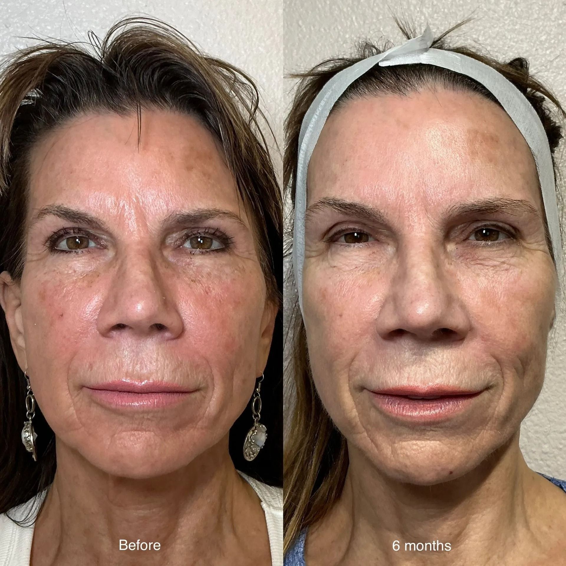 NeoGen PSR before and after comparison at Good Skin Aesthetics in Loomis, California