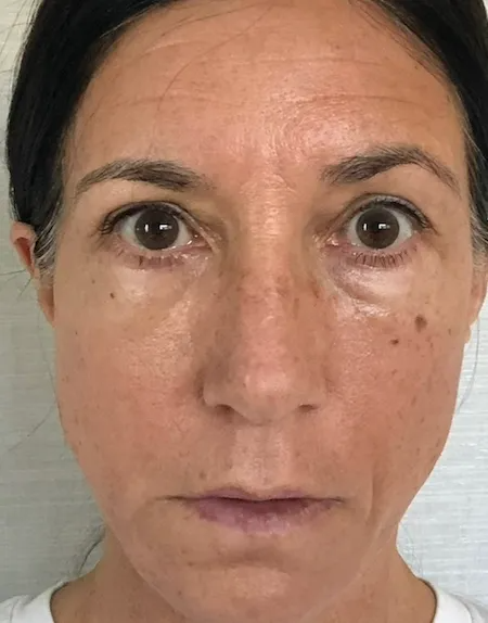 Healing Stage 6 Days After NeoGen plasma skin regeneration