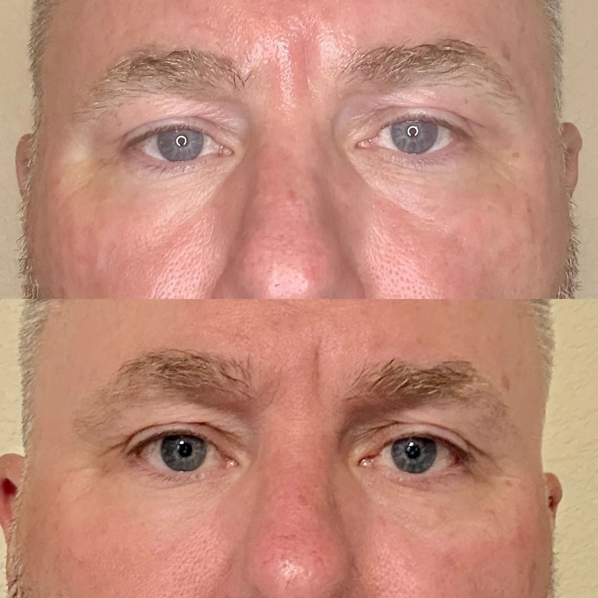 NeoGen PSR eye area before and after comparison at Good Skin Aesthetics in Loomis, California