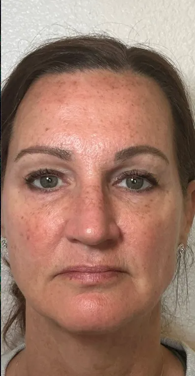 Front Facing before NeoGen plasma skin regeneration