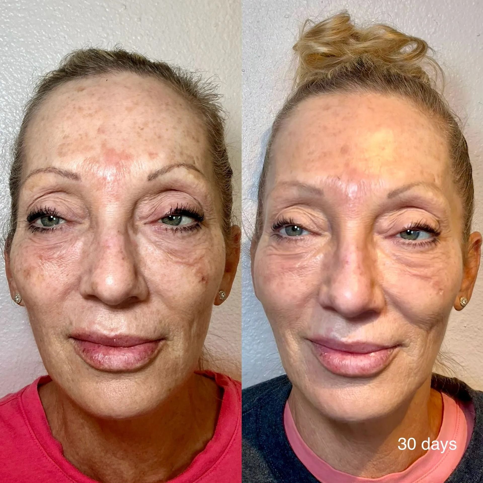 NeoGen PSR full face before and after comparison at Good Skin Aesthetics in Loomis, California