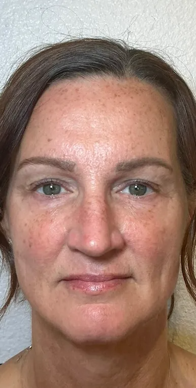 Front Facing 90 Days After NeoGen plasma skin regeneration