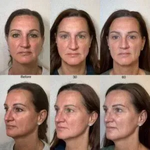 Before, 30 day, and 60 day photos showing skin firmness and texture after NeoGen plasma skin regeneration at Good Skin Aesthetics in Loomis, California