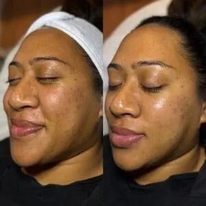 Before and after a brightening corrective facial at Good Skin Aesthetics in Loomis, California