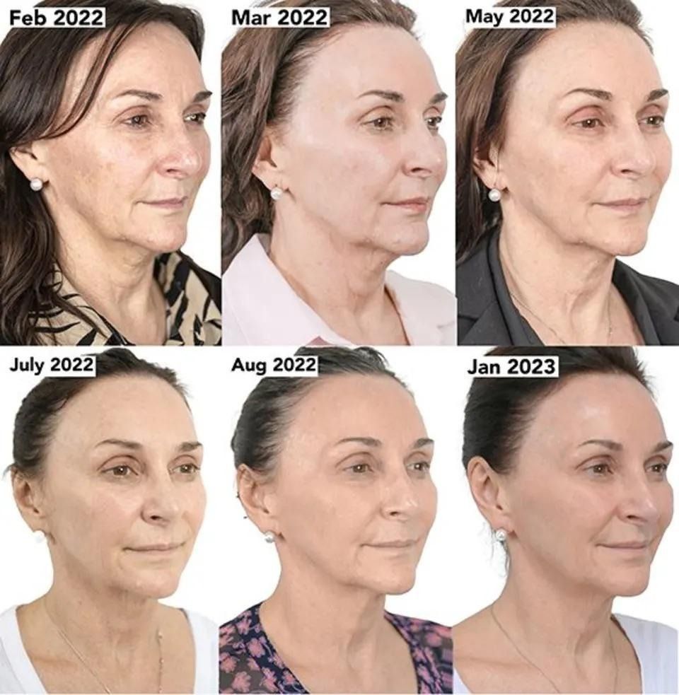 NeoGen PSR results progression over one year showing continued collagen remodeling