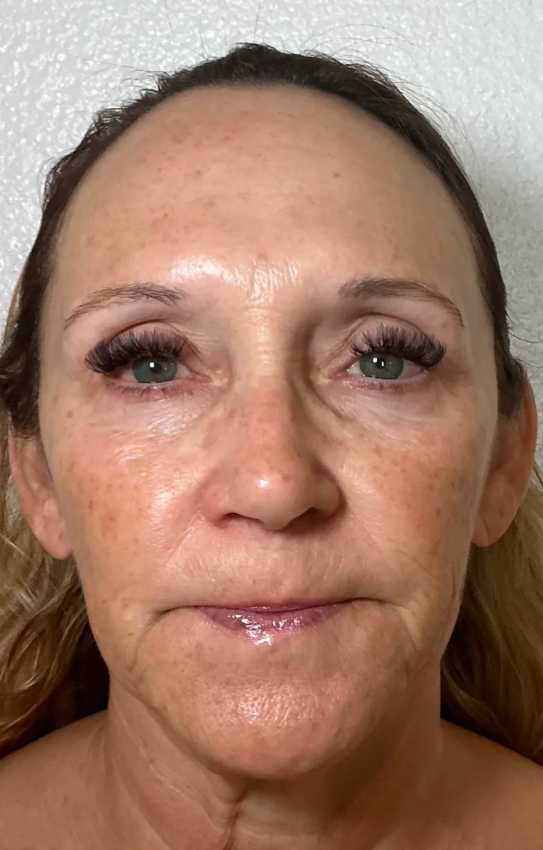 Eye Area before NeoGen plasma skin regeneration