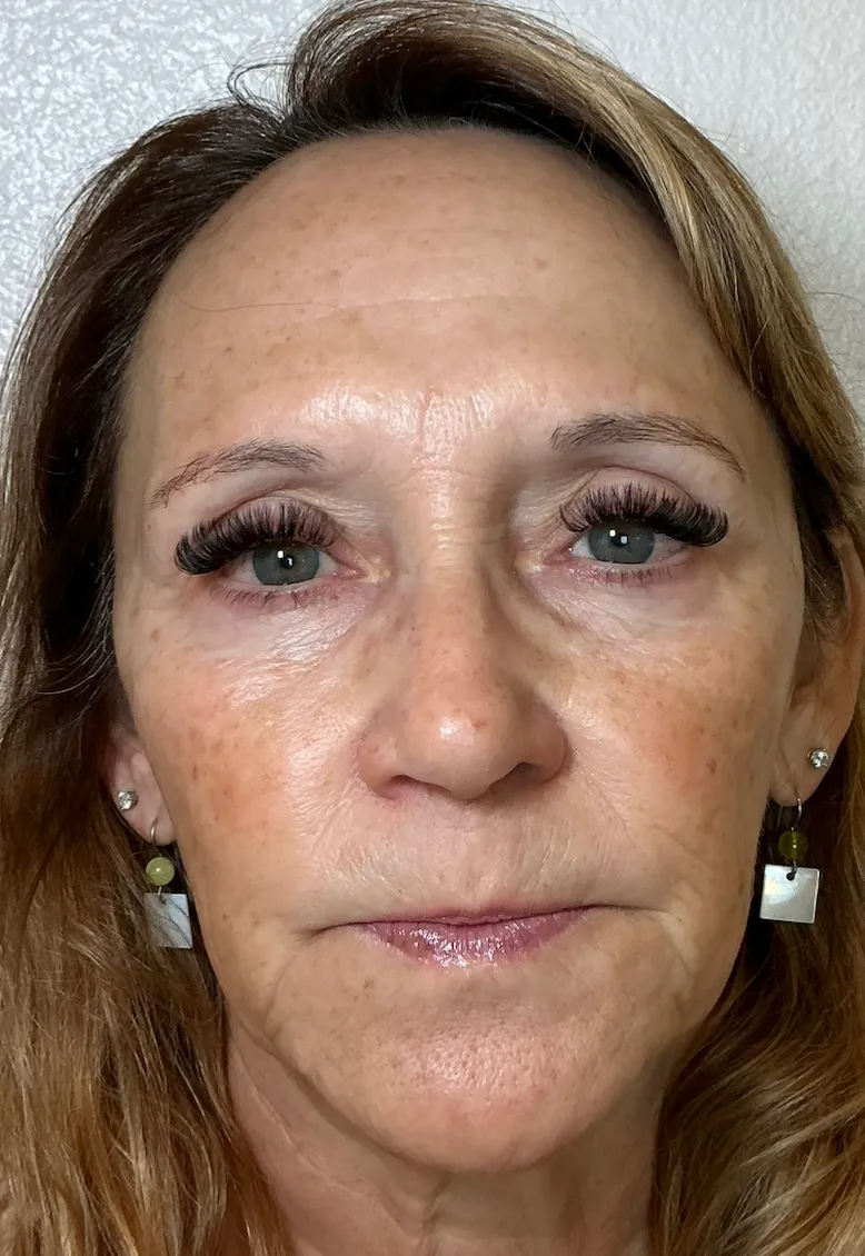 Eye Area 90 Days After NeoGen plasma skin regeneration