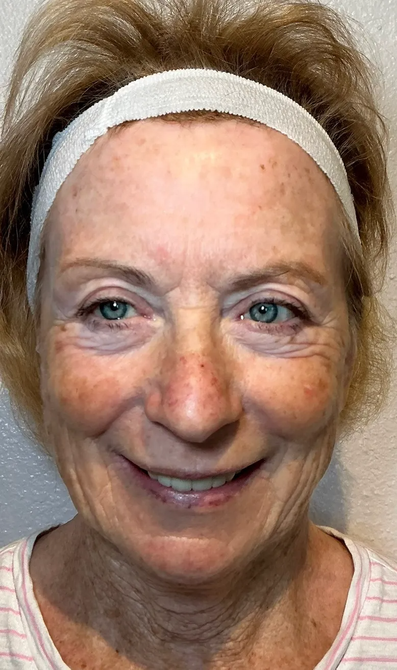 Full Face before NeoGen plasma skin regeneration