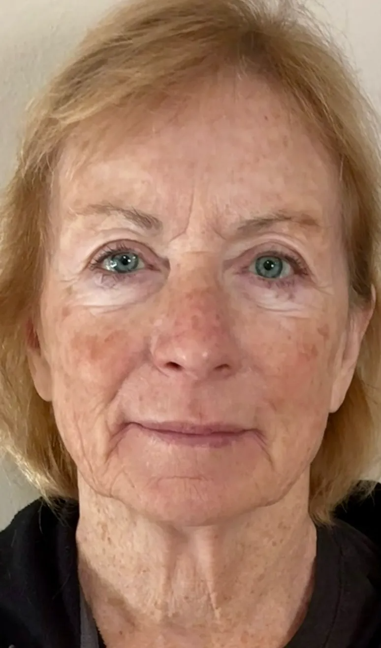 Full Face 30 Days After NeoGen plasma skin regeneration