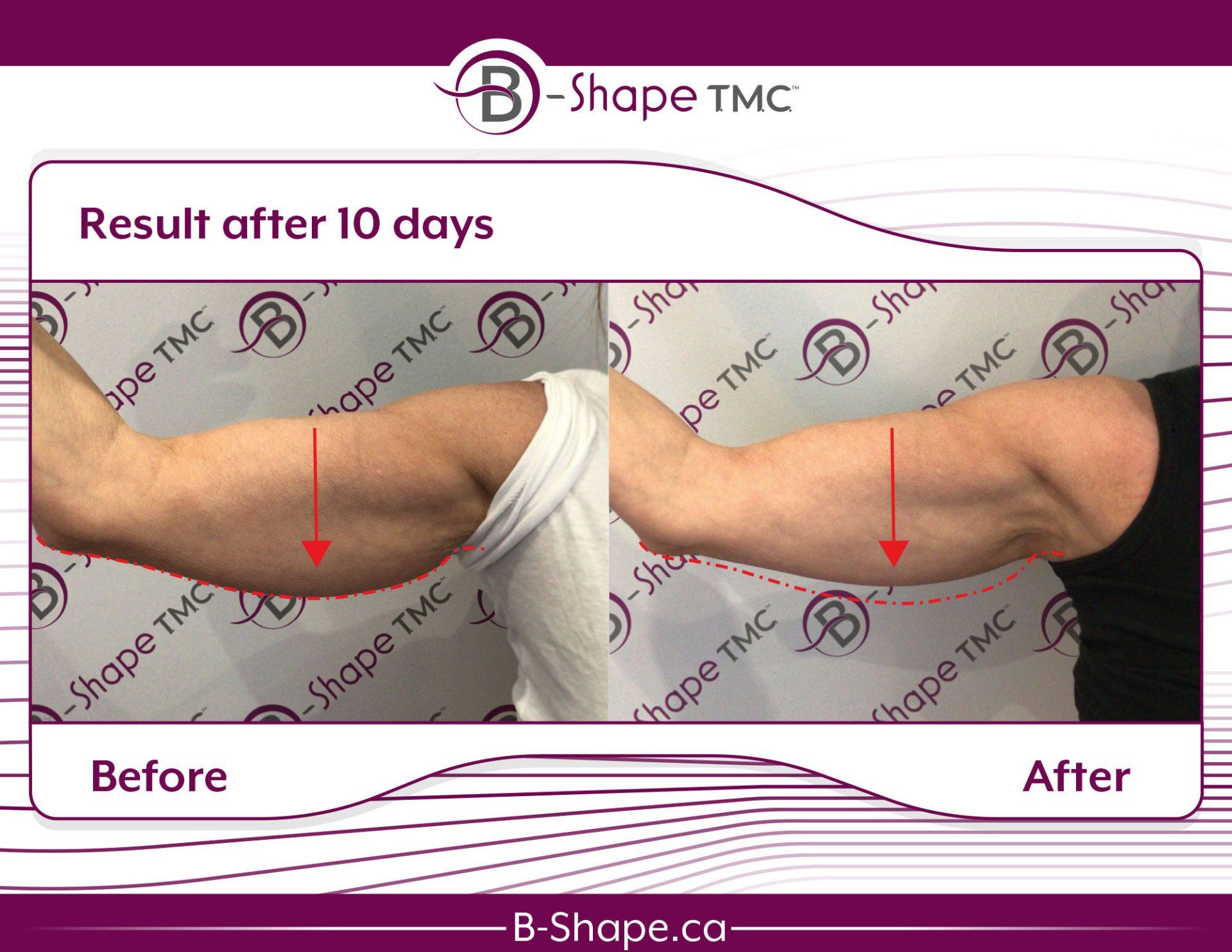 Comparison of an arm before and after a 10-day B-Shape TMC treatment, showing reduced arm size.