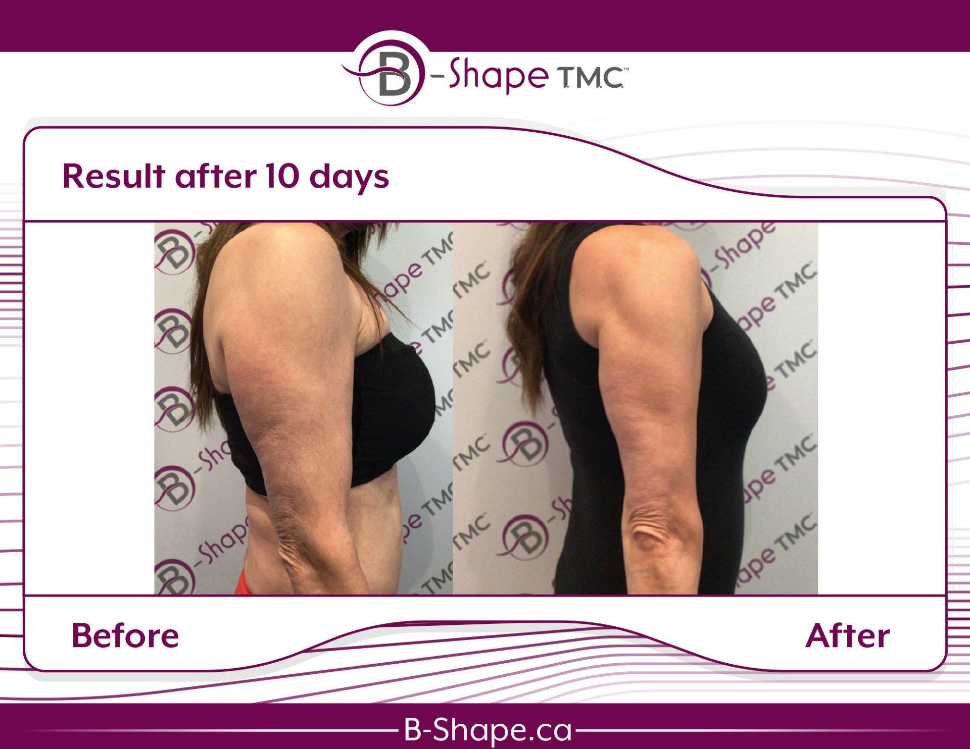 Comparison of a woman's arm before and after 10 days of B-Shape TMC treatment, showing reduced arm fat.