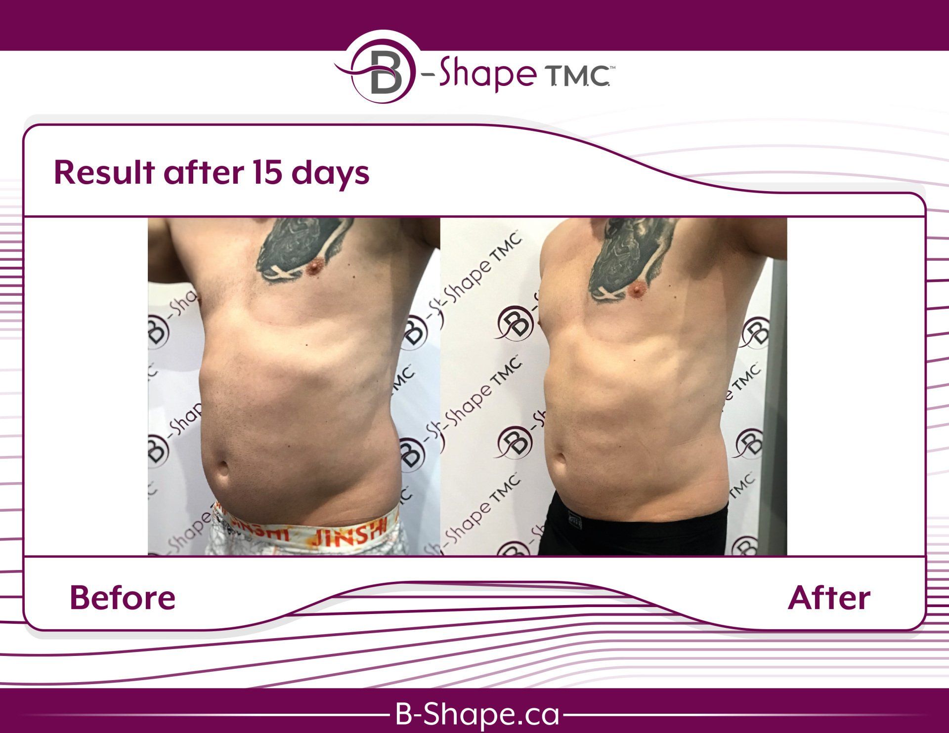 Side-by-side comparison showing a man's midsection before and after a 15-day B-Shape TMC treatment, with improved definition.
