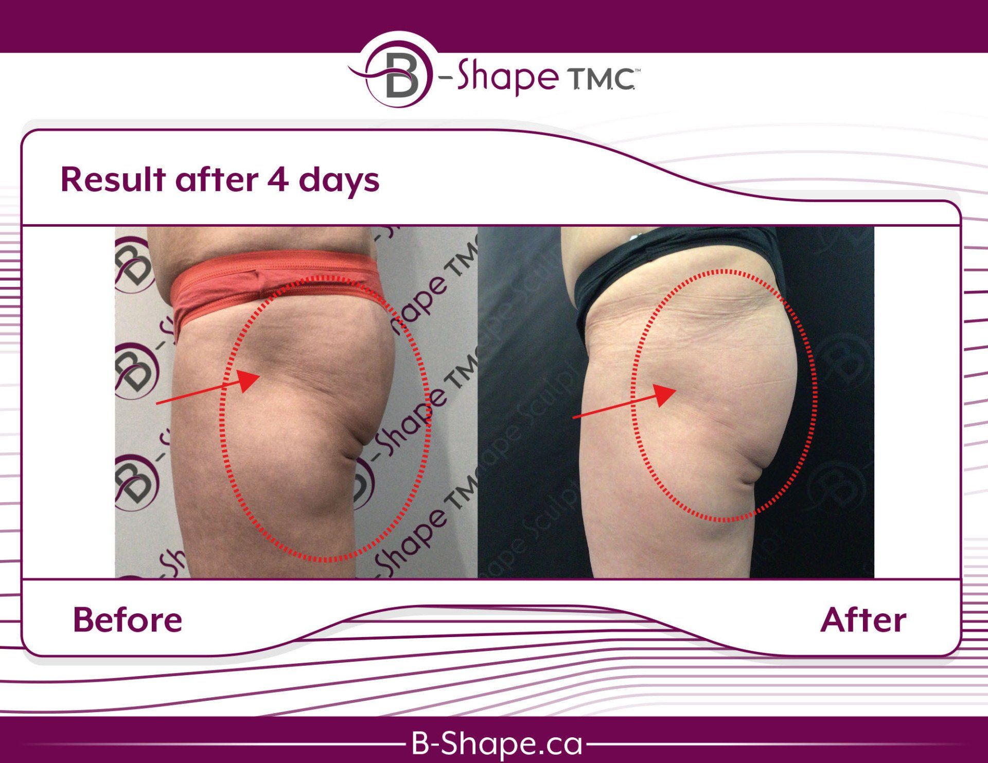 Before and after photos showing reduction in thigh cellulite after 4 days of B-Shape TMC treatment.